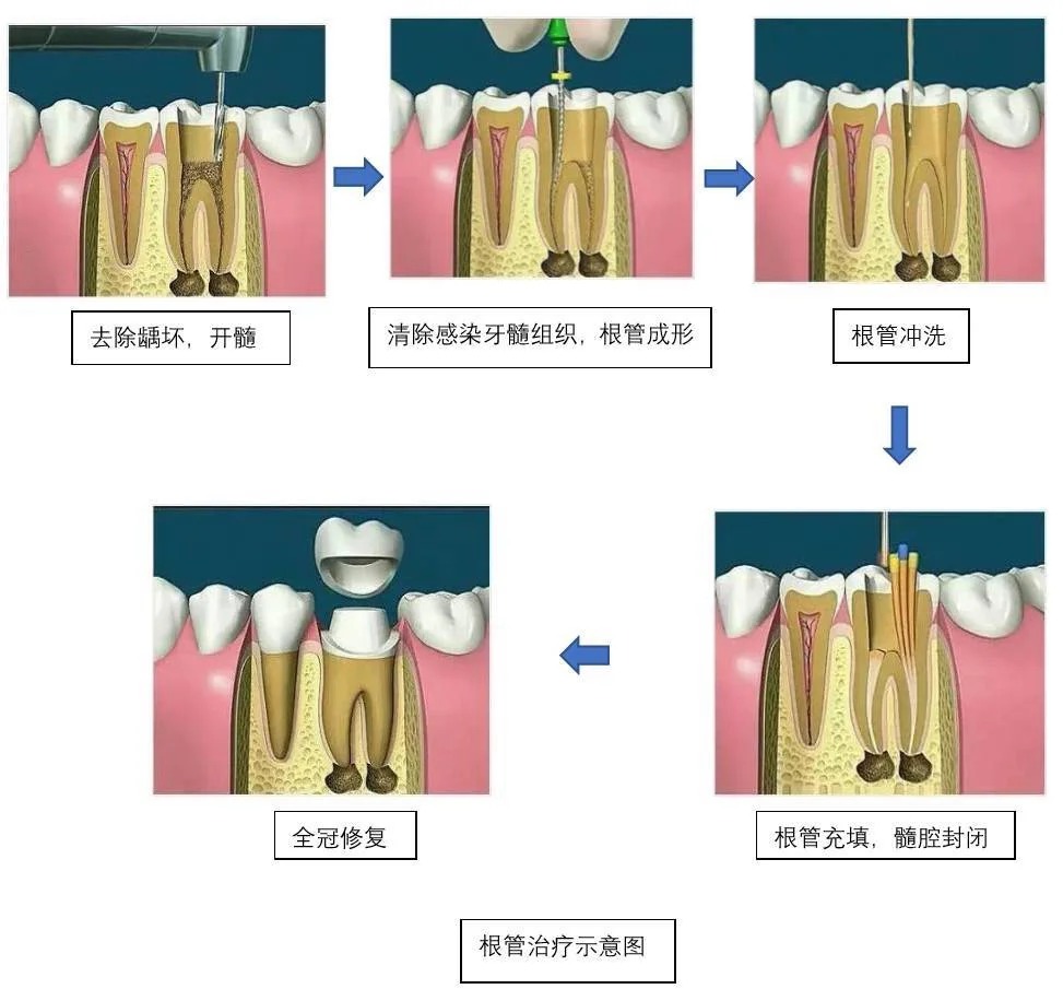 吃药VS根管治疗，哪个更能解决牙疼？_1_和欢_来自小红书网页版.jpg