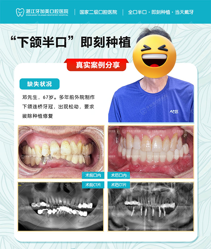 53350503.jpg 01种植案例(下颌半口)邓大发✓ 拷贝.jpg